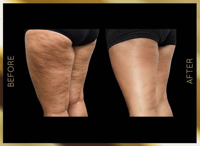 Before and after thigh contouring result