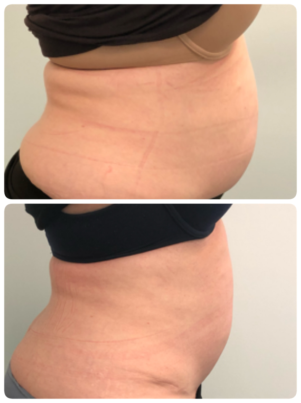 Before and after profile contouring result